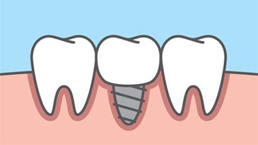 single dental implant in lower arch