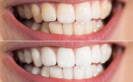 teeth whitening before and after