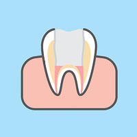 tooth filled with composite resin