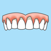 advanced periodontitis